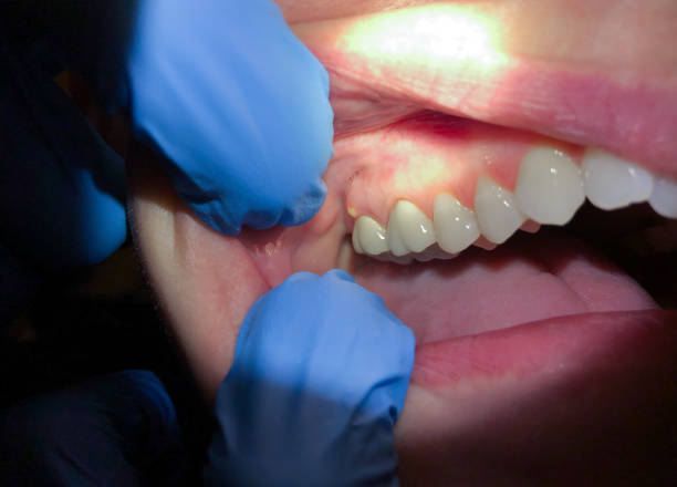 Best Emergency Treatment for Dental Infections or Abscesses in Port St Joe, FL
